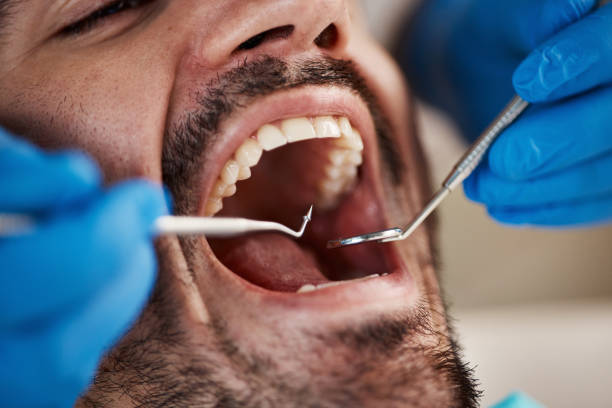 Best Knocked-Out Tooth (Avulsed Tooth) Treatment in Lenox, IA